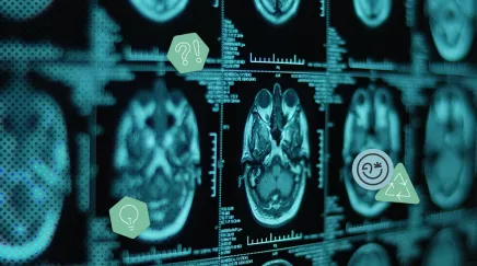 Images d'IRM cérébrales affichées sur un écran médical